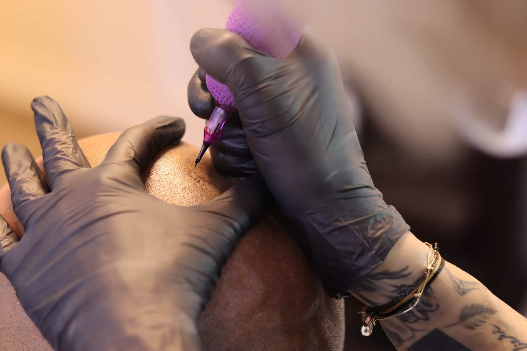 Une séance de tricopigmentation, tatouage pour camoufler la chute capillaire