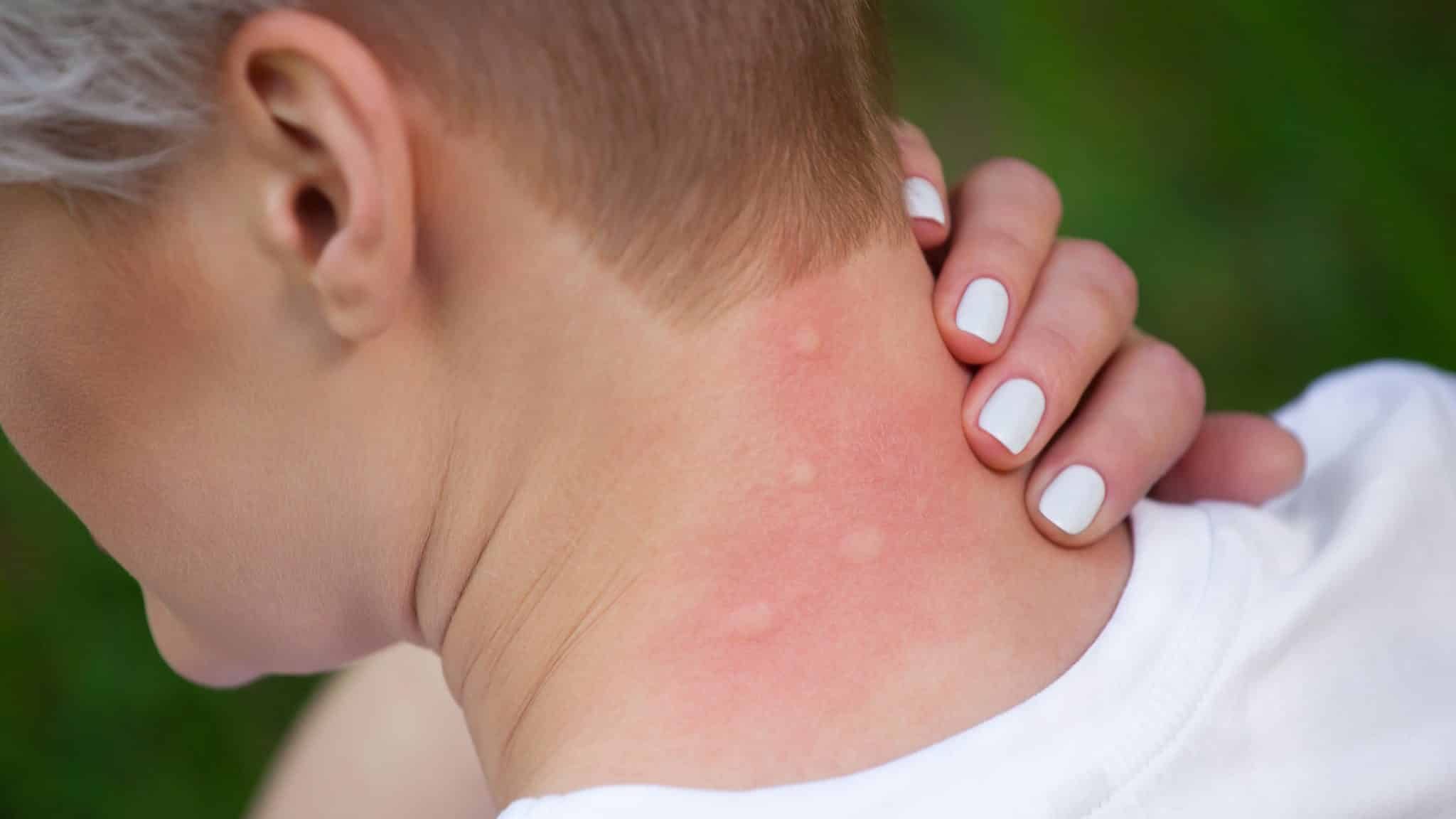 Dix astuces pour éviter et soulager les piqûres de moustiques