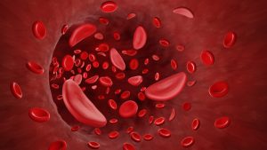 Globules rouges atteints pas la drépanocytose