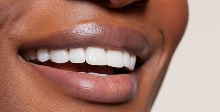 Limage des dents