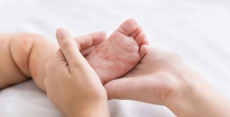 Rougeole : se vacciner pour « protéger la population et soi-même » rappelle le Dr Millot