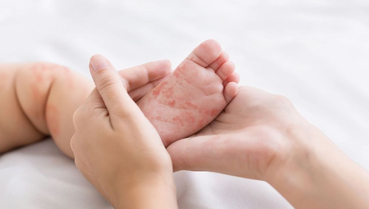 Rougeole : se vacciner pour « protéger la population et soi-même » rappelle le Dr Millot